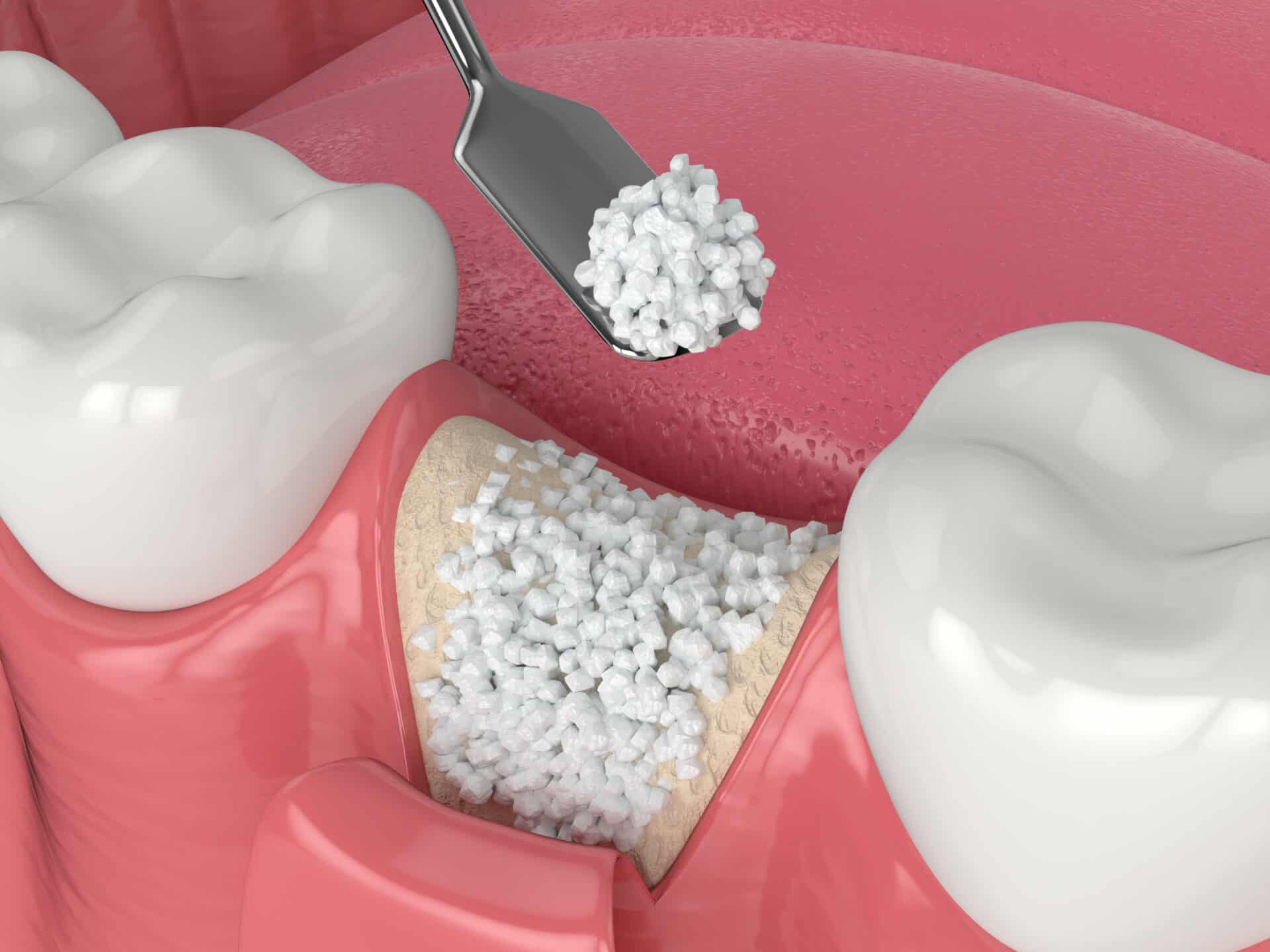 3D render of dental bone grafting with bone biomaterial application