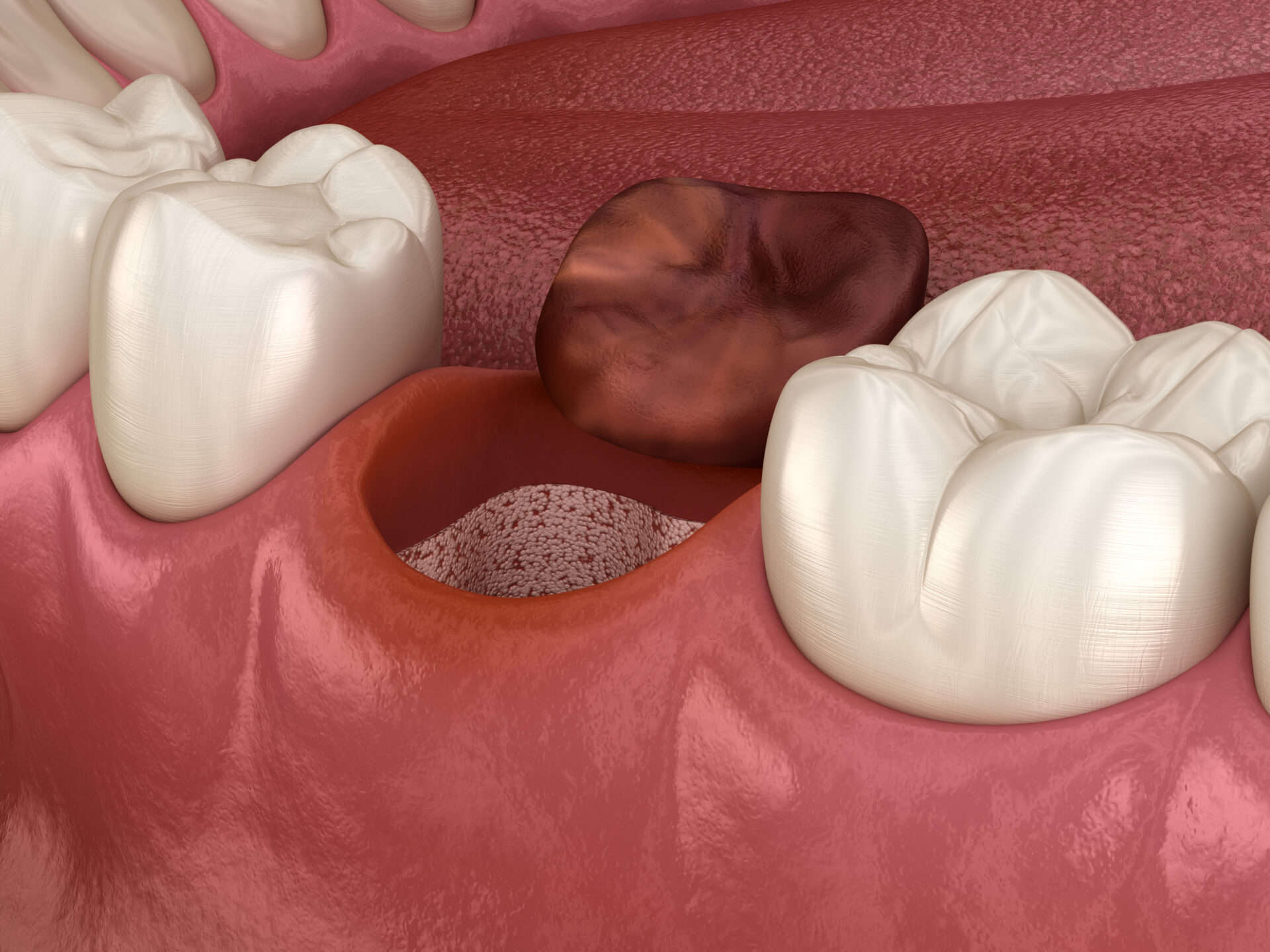 dry socket solutions - Anthem Oral Surgery